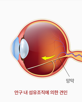 망막 / 안구 내 섬유조직에 의한 견인